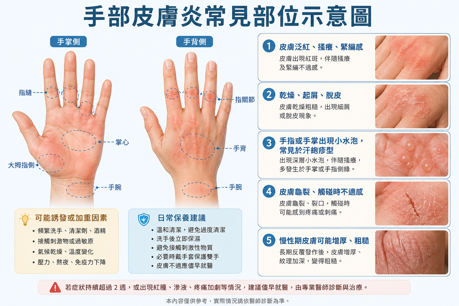 手部皮膚炎常見部位示意圖